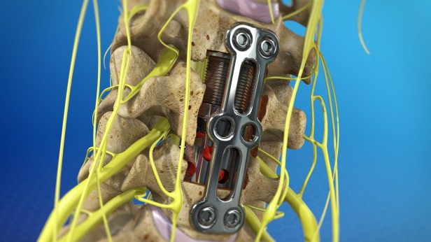 Know About Carpectomy