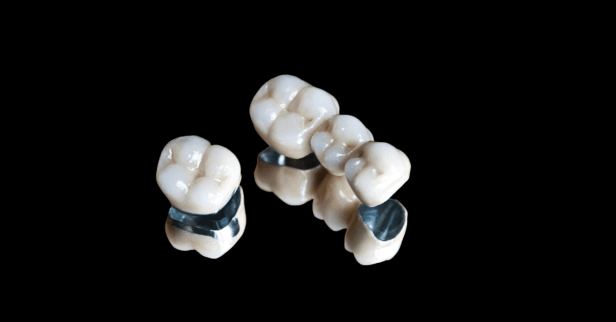 Dental Crowns or Bridges