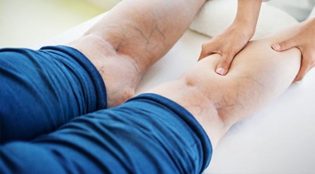 Treating Chronic Venous Insufficiency